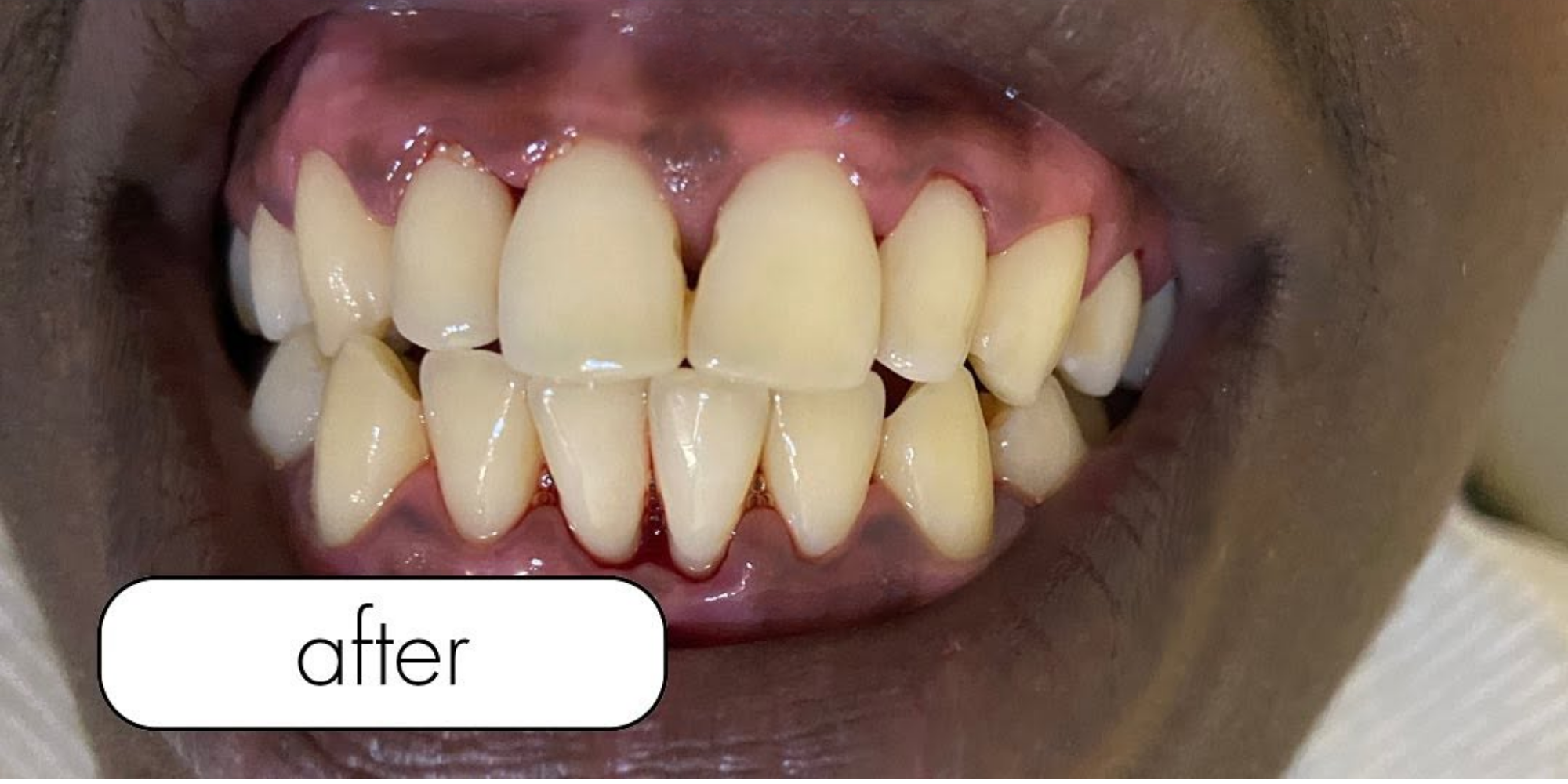 A patient's smile after treatment at New Dawn Dental Studio