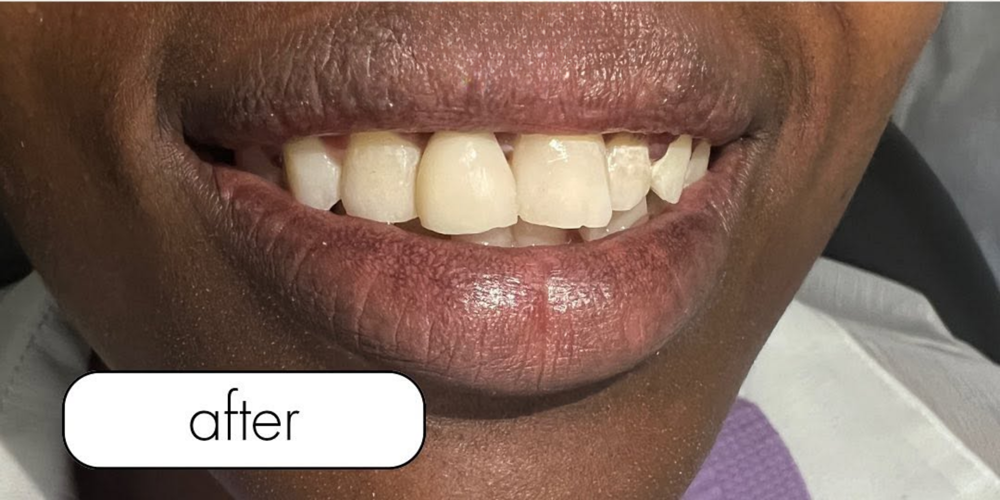 A patient's smile after treatment at New Dawn Dental Studio