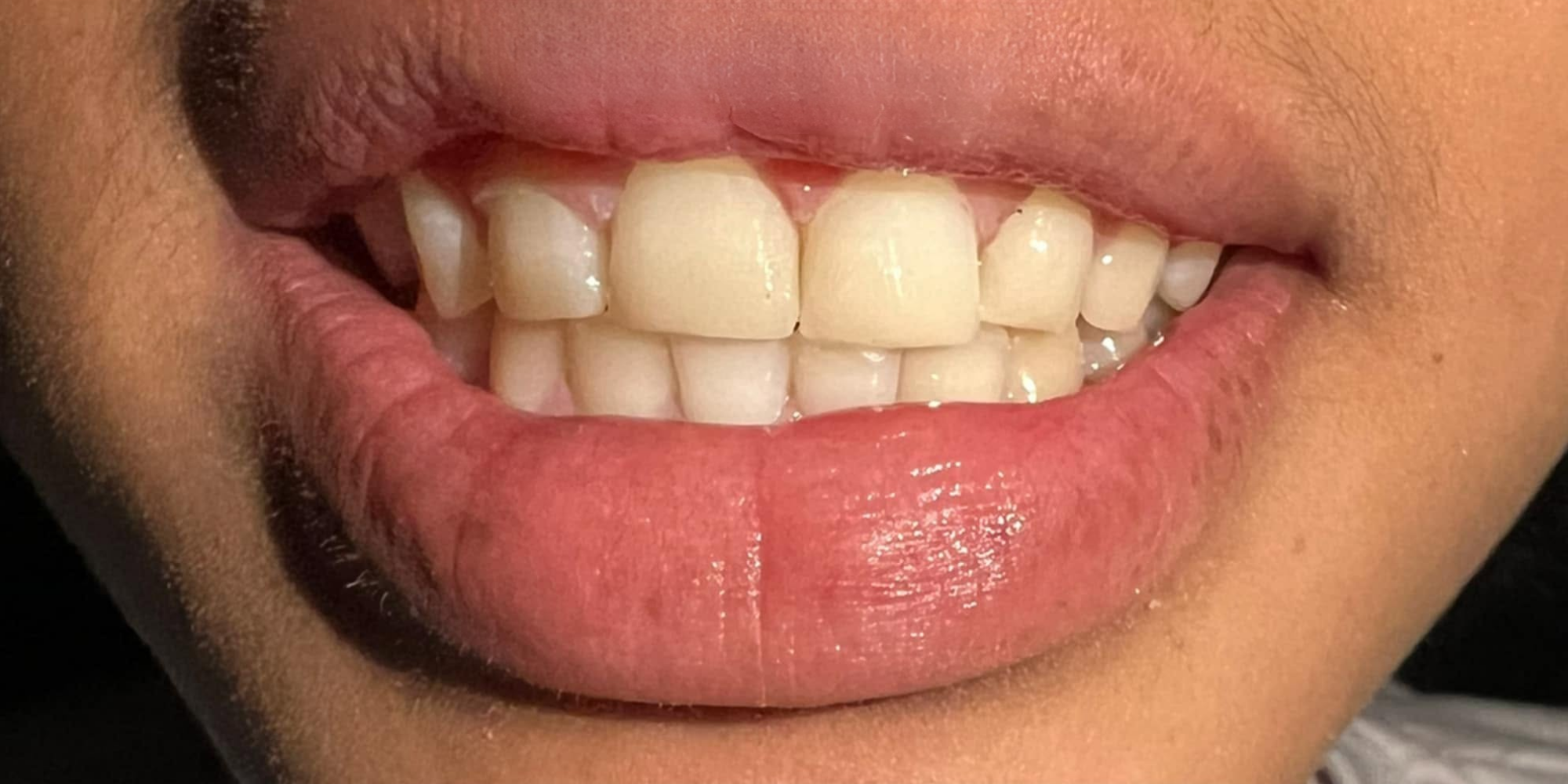 A patient's smile after treatment at New Dawn Dental Studio