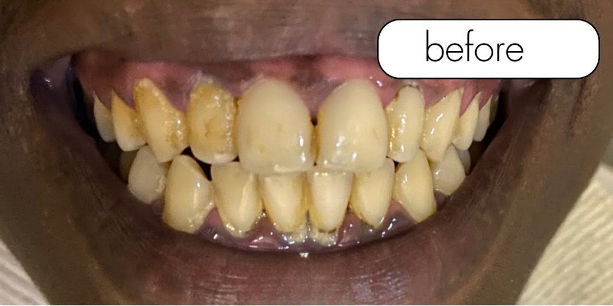 The same patient's smile before treatment