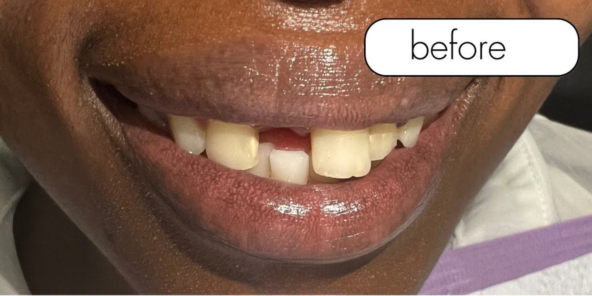 The same patient's smile before treatment