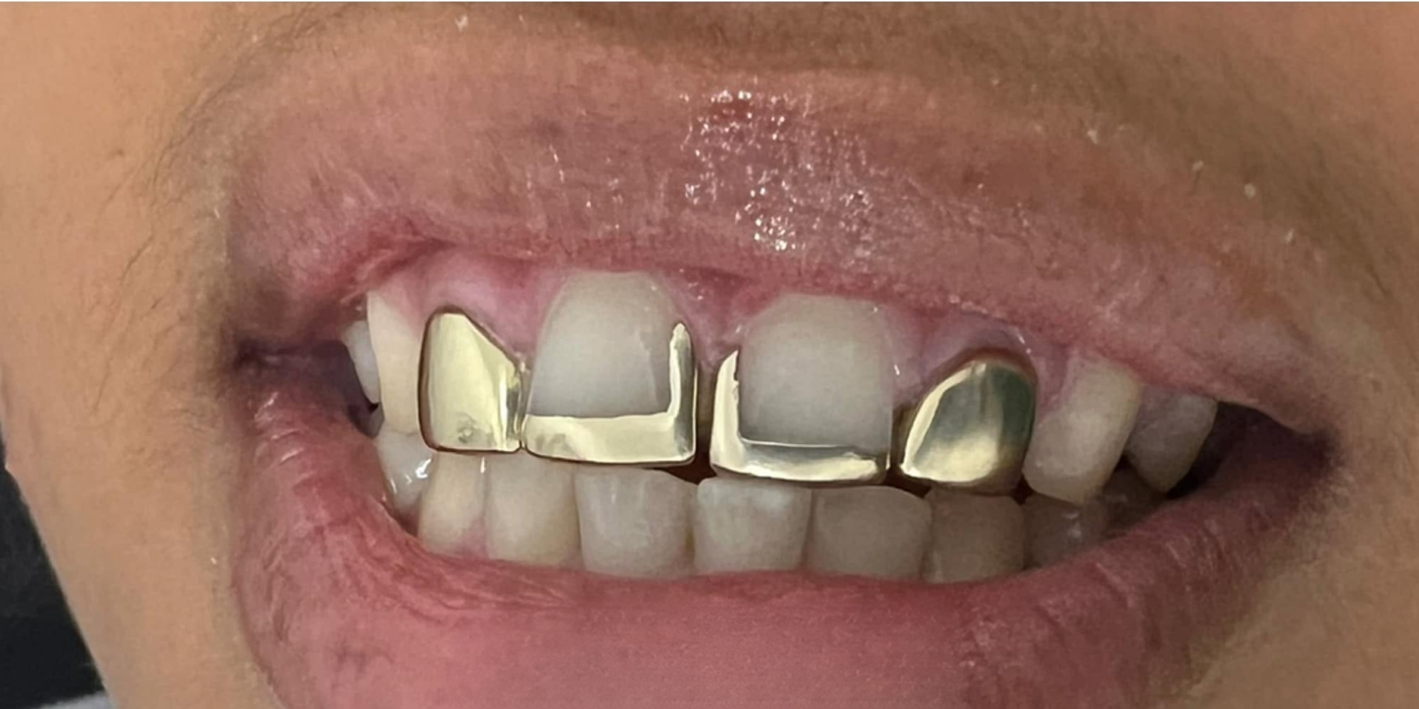 The same patient's smile before treatment